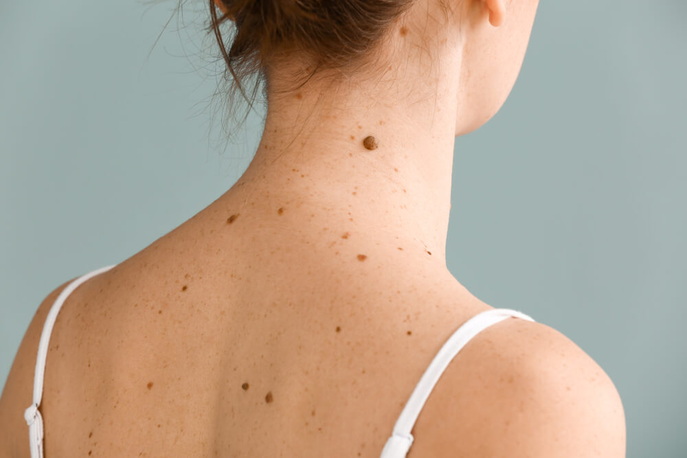 Young woman with moles on grey background