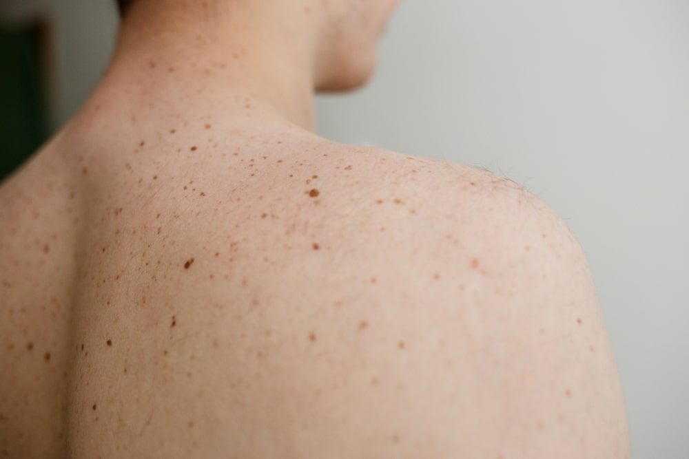Close up detail of the bare skin on a man back with scattered moles and freckles , Disorders of body
